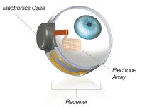 bionic eye