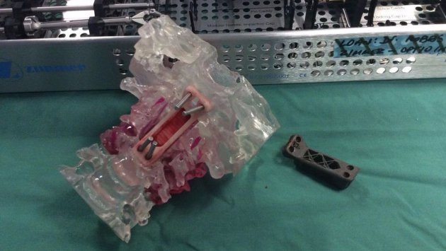 Doctors Implant 3D-Printed Vertebrae