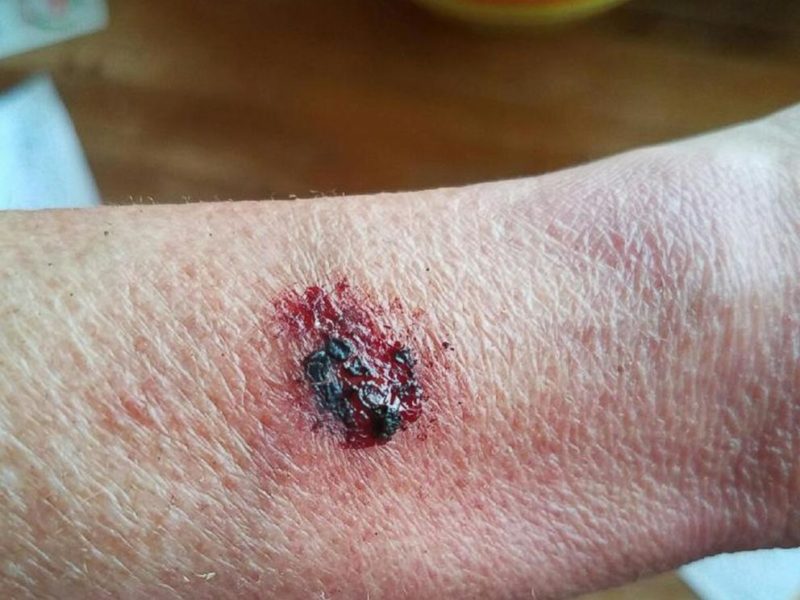 Second-Degree Burns After Fitbit Flex 2 Explodes | eTeknix